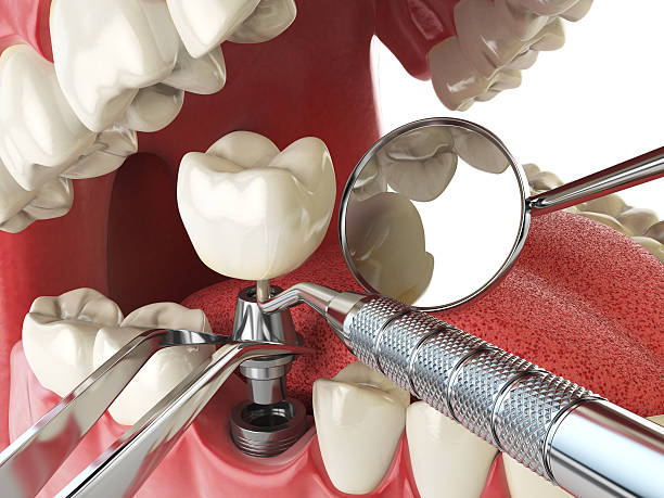 Best Emergency Tooth Extraction in Howards Grove, WI